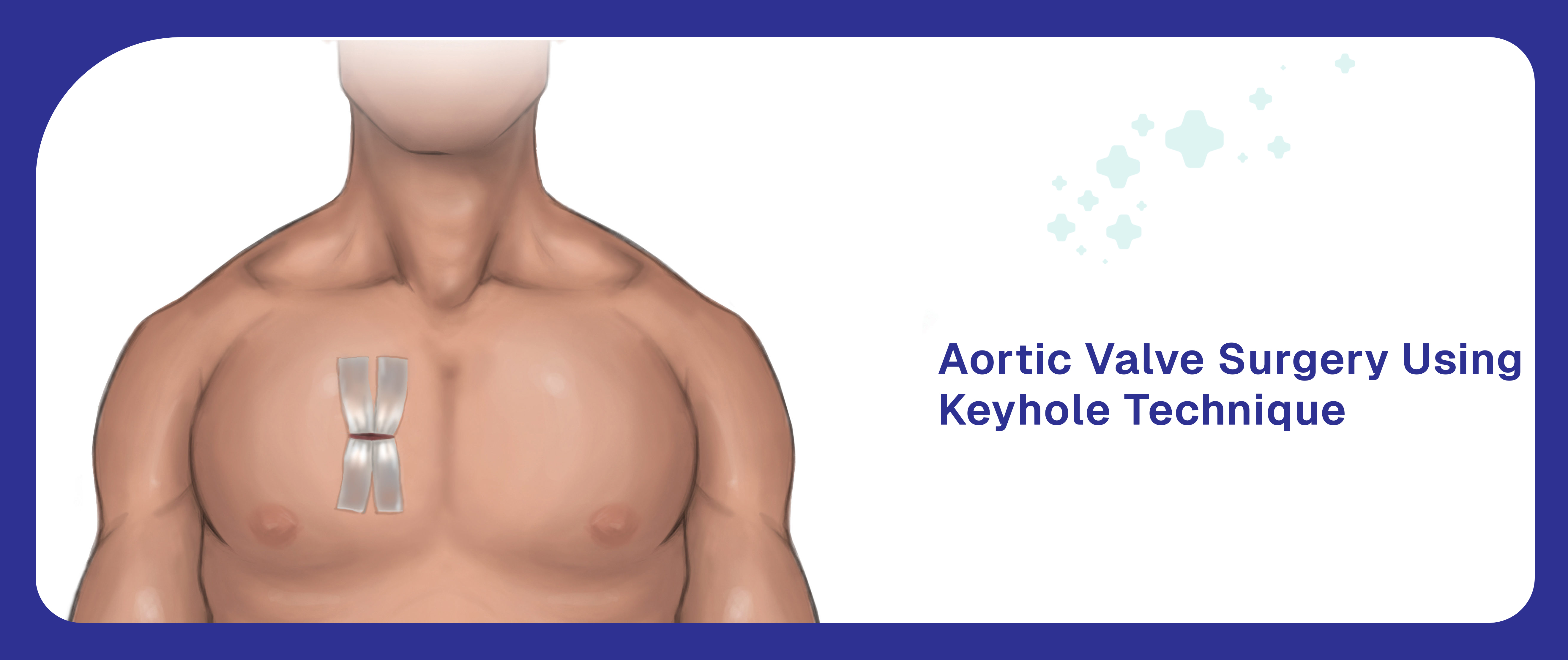 AORTIC VALVE SURGERY USING KEYHOLE TECHNIQUE